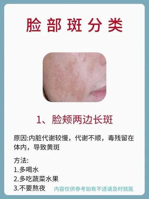脸上的雀斑怎样去掉(永久的去掉)缩略图