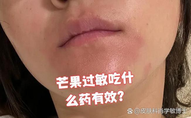 芒果过敏吃什么药最有效缩略图