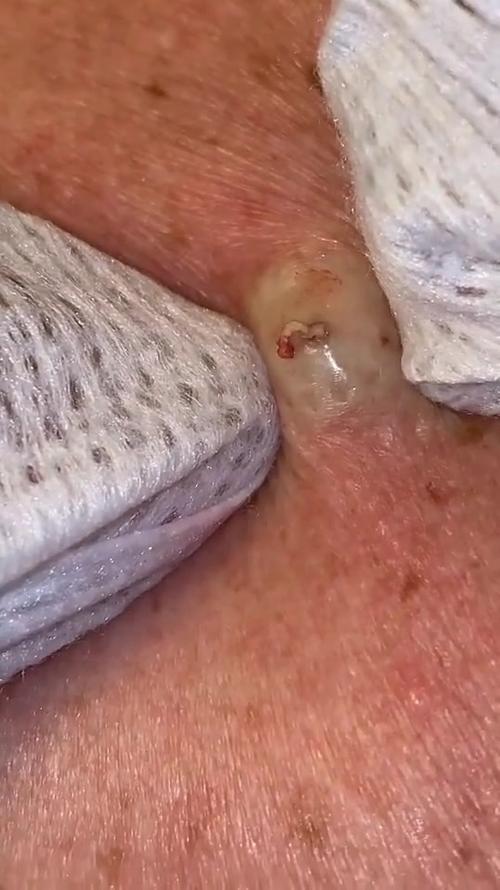 重度挤痘痘视频图标