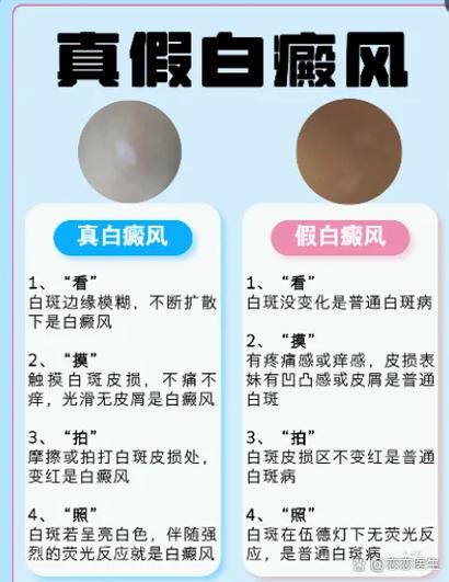 如何判断白斑是不是白风游戏截图