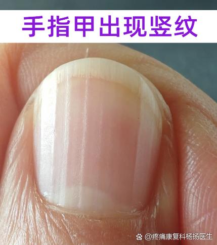 大拇指有竖纹是怎么回事缩略图
