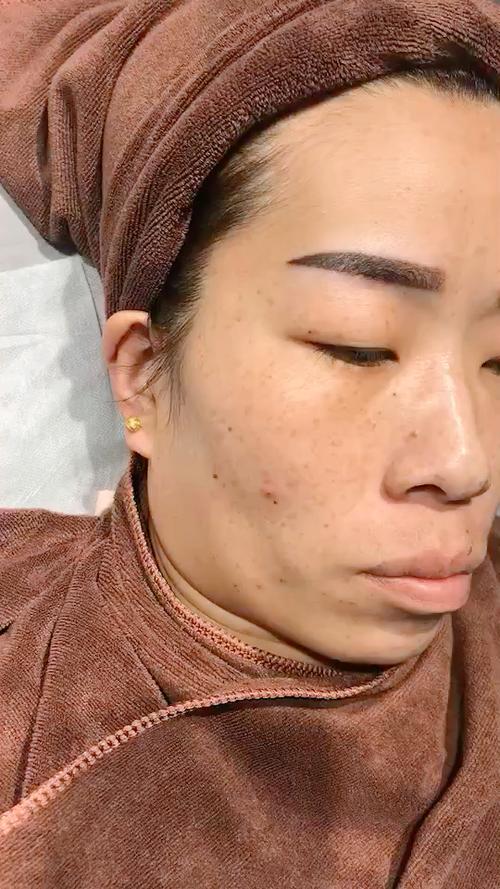 遗传雀斑怎么治疗才能彻底除根缩略图