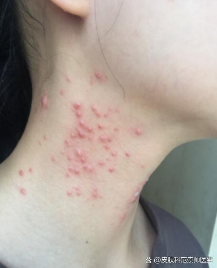 皮肤长痘痘去医院挂什么科图标