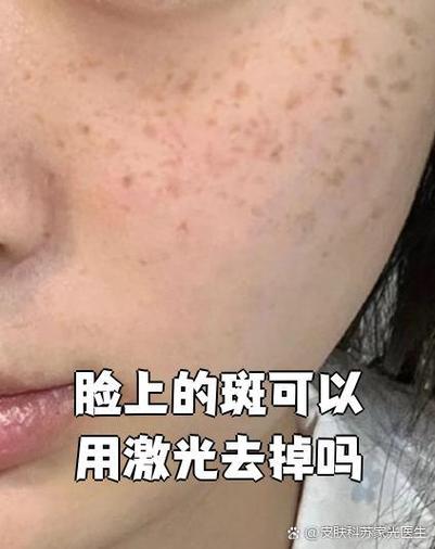 脸上雀斑能彻底去掉吗缩略图