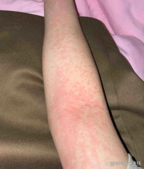 膏药贴了皮肤过敏红痒怎么办游戏截图