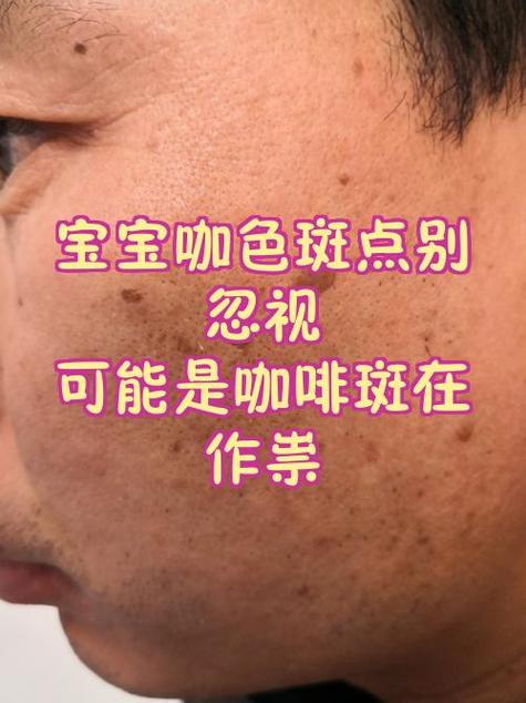 小腿上有咖啡斑怎么去除缩略图