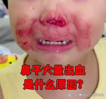 什么病有流鼻血的症状图标