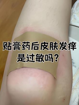 贴膏药后留下的胶怎么除掉缩略图