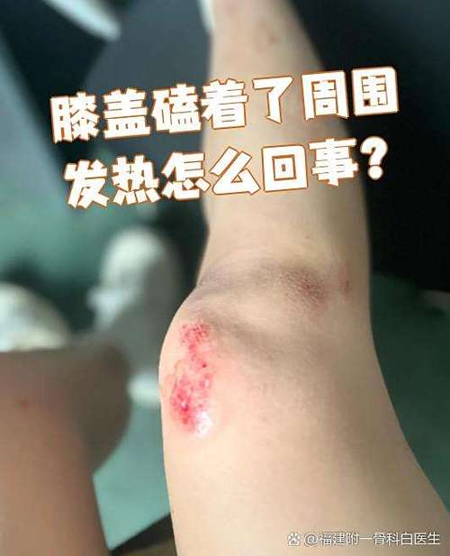 膝盖摔了发热是好是坏缩略图