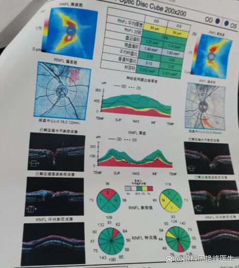 oct检查眼睛可以检查出什么缩略图