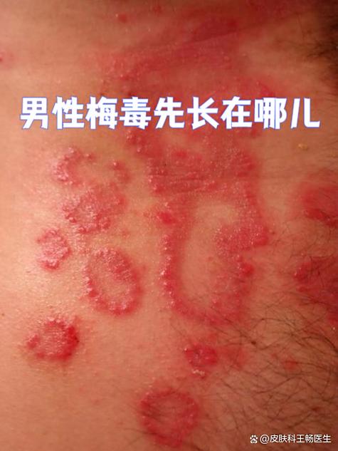 男性得了性疾病有什么症状图标