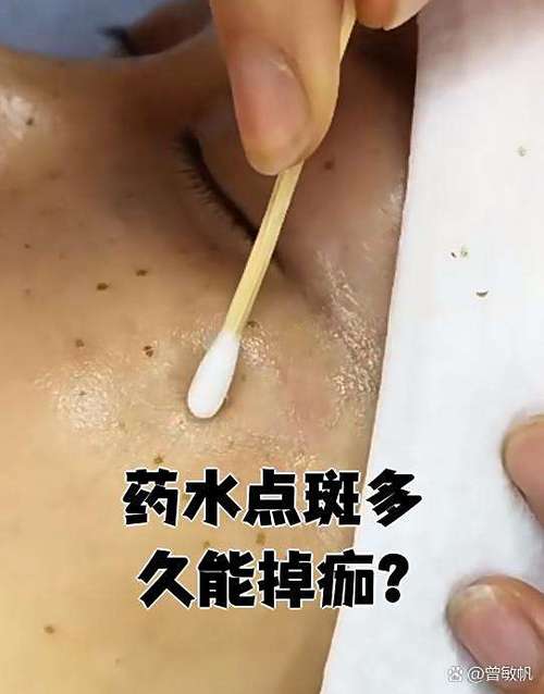 药水点斑能彻底去掉吗游戏截图