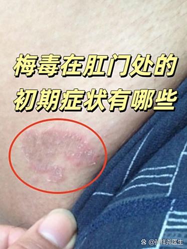 男性得了性疾病早期有什么症状图标