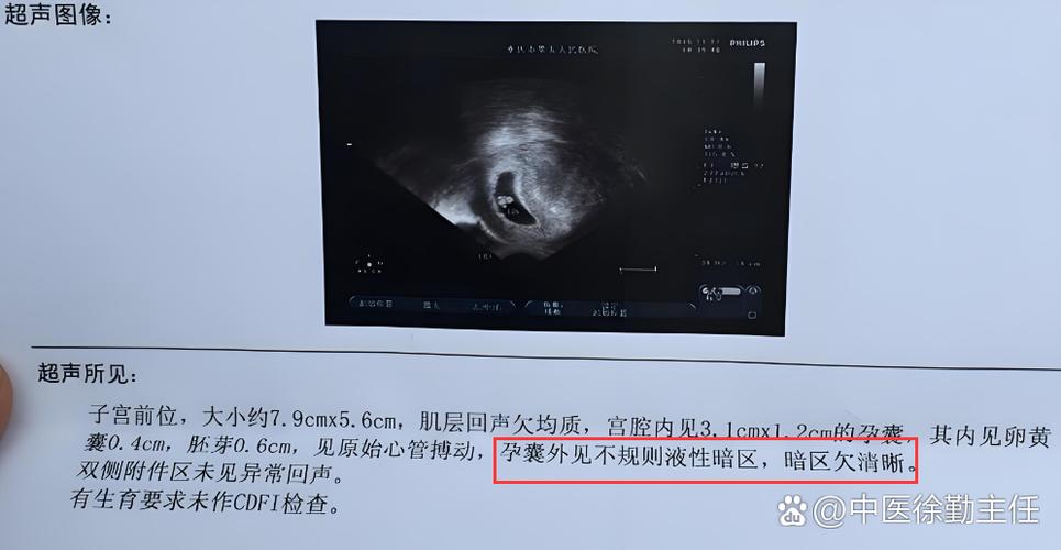 怀孕35天宫内暗区是宫内孕吗图标