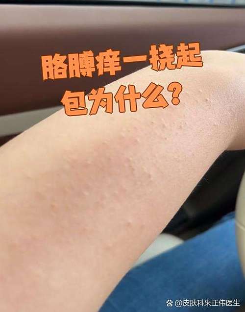 一挠胳膊上就起小疙瘩是怎么回事缩略图