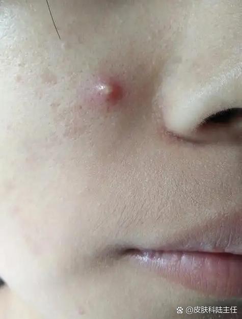 脓包痘痘能挤掉吗图标