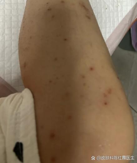 腿和胳膊痒痒,一挠就出现一片小疙瘩缩略图