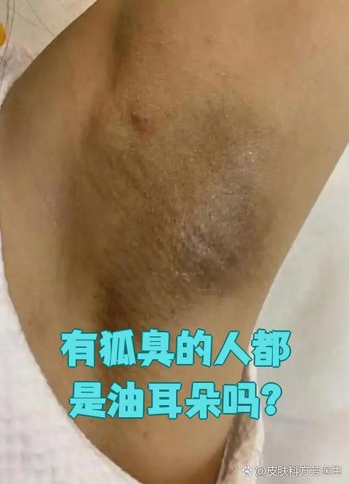 油耳朵一定会是狐臭吗缩略图