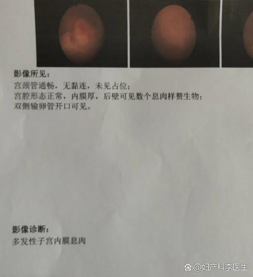 子宫息肉吃药能消除吗图标