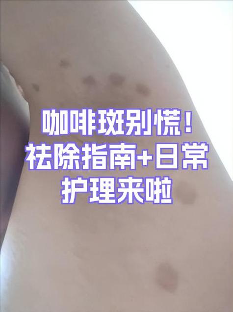 咖啡斑能彻底去除吗游戏截图