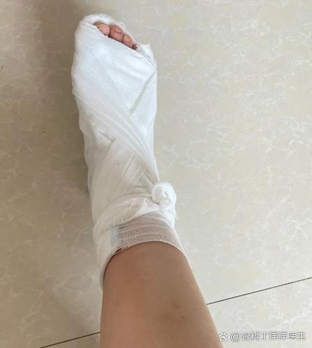 脚趾头骨折用脚后跟走路缩略图