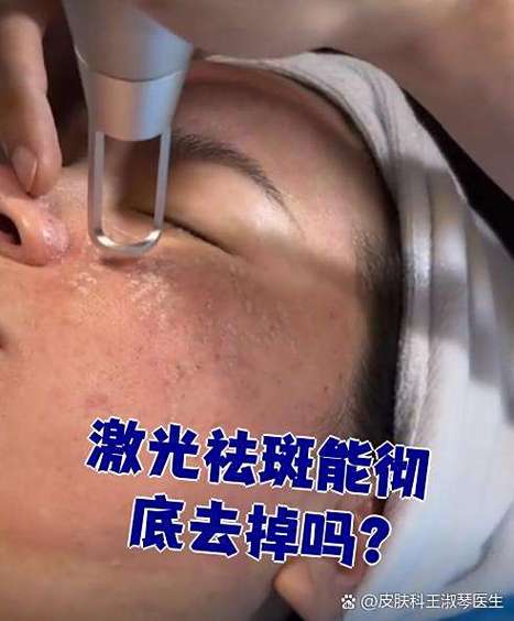 遗传斑可以彻底去除吗缩略图