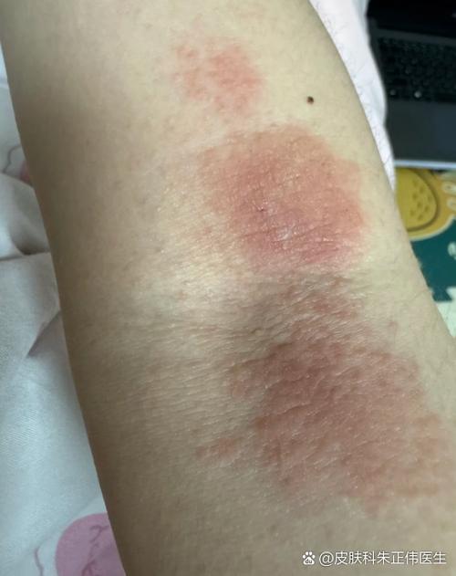 胳膊突然起了一片疙瘩很痒图标