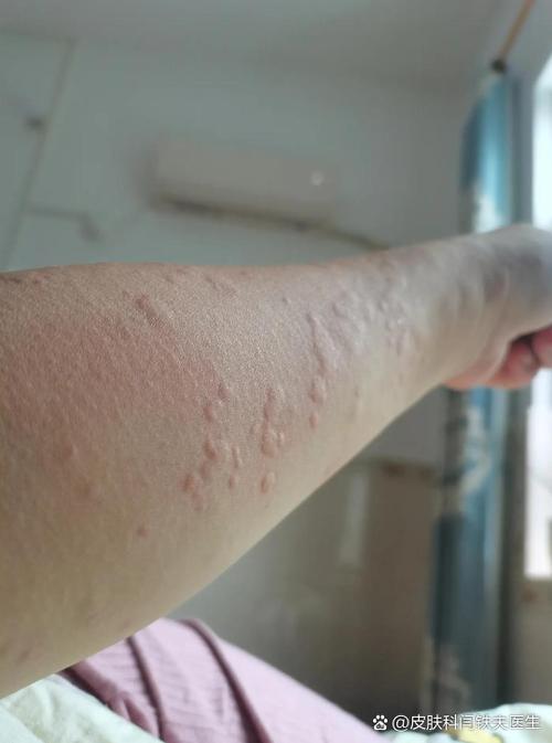 胳膊弯痒一挠就起疙瘩图标