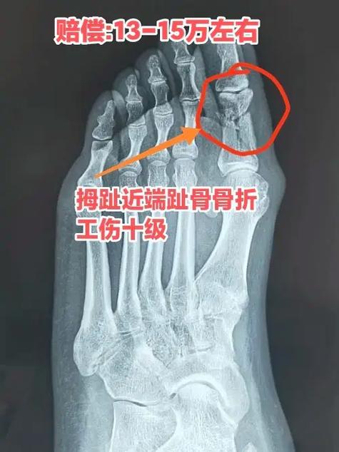 工伤脚趾骨折赔偿多少钱图标