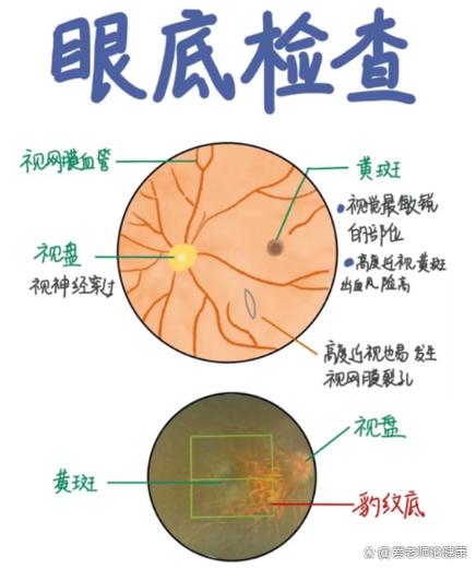 为什么医生不建议做眼底检查缩略图