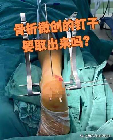 骨折钢钉取不取图标